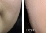 Injectables Before and After Photos in Miami, FL, Patient 1557