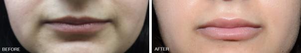 Injectables Before and After Photos in Miami, FL, Patient 1557