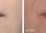 Injectables Before and After Photos in Miami, FL, Patient 1561