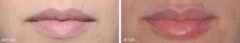 Injectables Before and After Photos in Miami, FL, Patient 1561