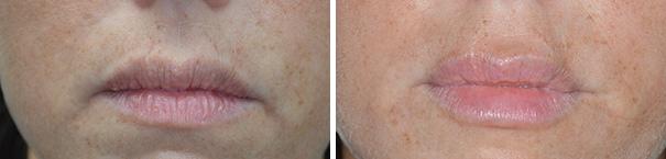 Injectables Before and After Photos in Miami, FL, Patient 1565