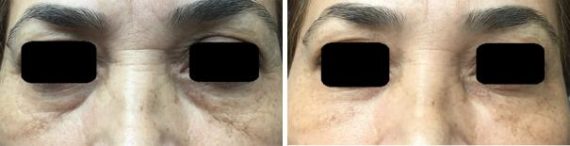 Injectables Before and After Photos in Miami, FL, Patient 1569