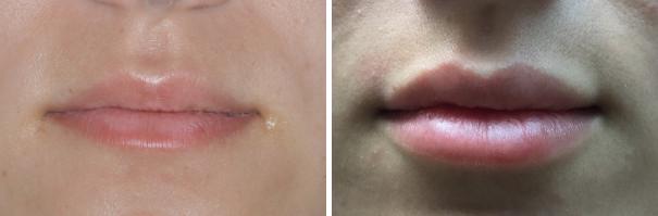 Injectables Before and After Photos in Miami, FL, Patient 1573