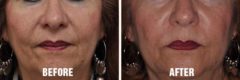 Injectables Before and After Photos in Miami, FL, Patient 1515