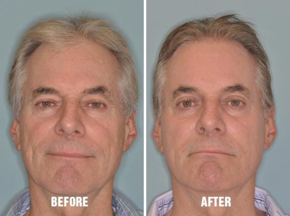 Injectables Before and After Photos in Miami, FL, Patient 1498