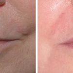 Injectables Before and After Photos in Miami, FL, Patient 1528