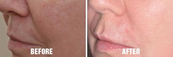 Injectables Before and After Photos in Miami, FL, Patient 1528