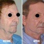 Laser Resurfacing Before and After Photos in Miami, FL, Patient 1508