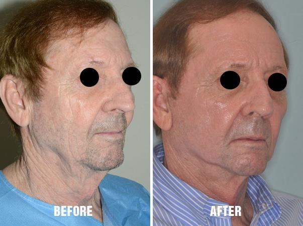 Laser Resurfacing Before and After Photos in Miami, FL, Patient 1508