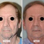 Laser Resurfacing Before and After Photos in Miami, FL, Patient 1508