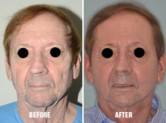 Laser Resurfacing Before and After Photos in Miami, FL, Patient 1508