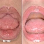 Lip Reduction Before and After Photos in Miami, FL, Patient 1460