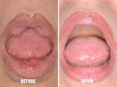 Lip Reduction Before and After Photos in Miami, FL, Patient 1460