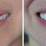 Lip Reduction Before and After Photos in Miami, FL, Patient 1494