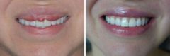 Lip Reduction Before and After Photos in Miami, FL, Patient 1494