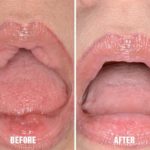 Lip Reduction Before and After Photos in Miami, FL, Patient 1460