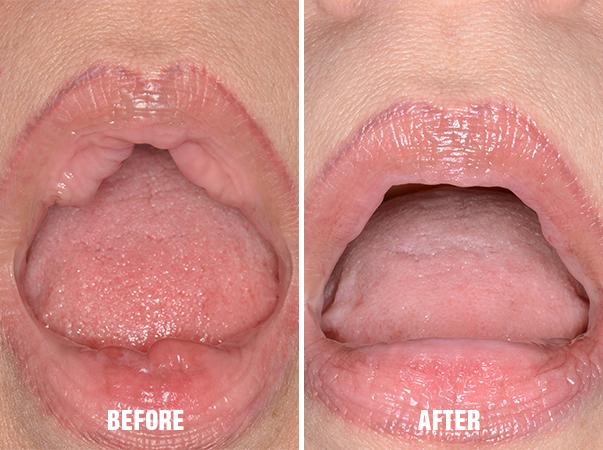 Lip Reduction Before and After Photos in Miami, FL, Patient 1460