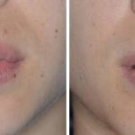 Lip Reduction Before and After Photos in Miami, FL, Patient 1467