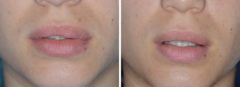 Lip Reduction Before and After Photos in Miami, FL, Patient 1467