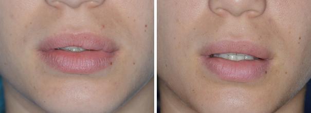 Lip Reduction Before and After Photos in Miami, FL, Patient 1467