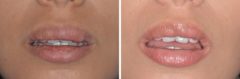 Lip Reduction Before and After Photos in Miami, FL, Patient 1478