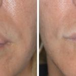 Lip Reduction Before and After Photos in Miami, FL, Patient 1482