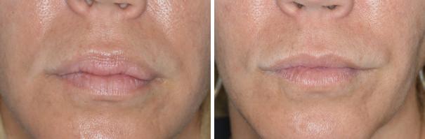 Lip Reduction Before and After Photos in Miami, FL, Patient 1482