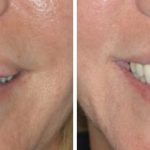 Lip Reduction Before and After Photos in Miami, FL, Patient 1482