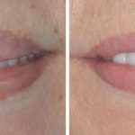 Lip Reduction Before and After Photos in Miami, FL, Patient 1490