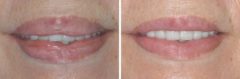 Lip Reduction Before and After Photos in Miami, FL, Patient 1490