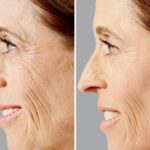 Non Surgical Before and After Photos in Miami, FL, Patient 1847