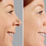 Non Surgical Before and After Photos in Miami, FL, Patient 1855