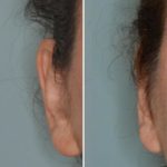 Otoplasty Before and After Photos in Miami, FL, Patient 1322