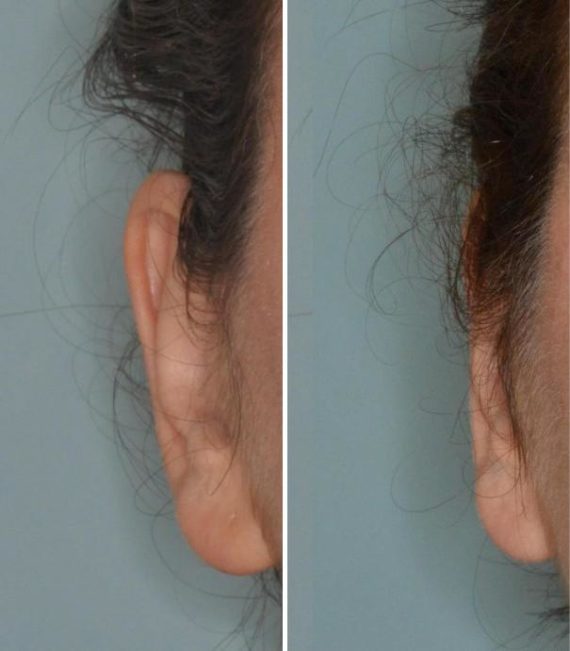 Otoplasty Before and After Photos in Miami, FL, Patient 1322