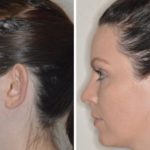 Otoplasty Before and After Photos in Miami, FL, Patient 1347