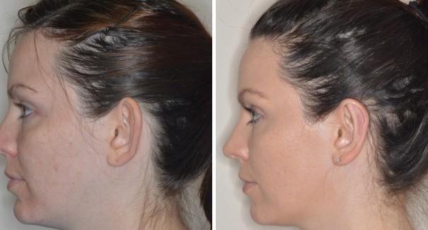 Otoplasty Before and After Photos in Miami, FL, Patient 1347