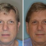 Otoplasty Before and After Photos in Miami, FL, Patient 1375