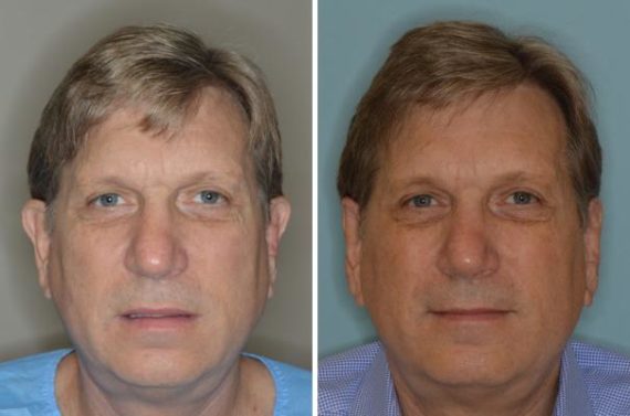 Otoplasty Before and After Photos in Miami, FL, Patient 1375