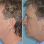 Otoplasty Before and After Photos in Miami, FL, Patient 1375