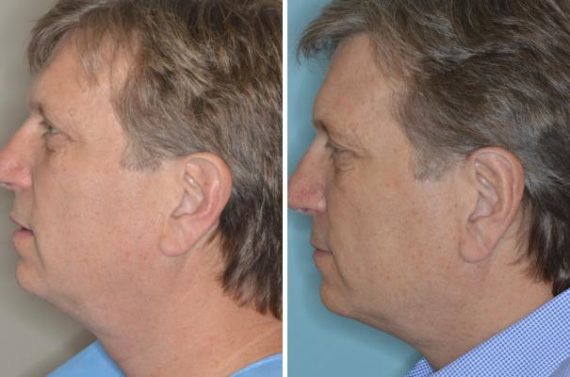 Otoplasty Before and After Photos in Miami, FL, Patient 1375