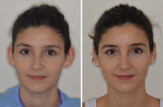 Otoplasty Before and After Photos in Miami, FL, Patient 1382