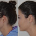 Otoplasty Before and After Photos in Miami, FL, Patient 1382