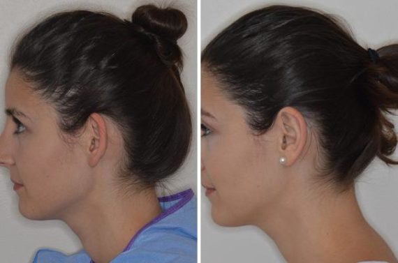 Otoplasty Before and After Photos in Miami, FL, Patient 1382