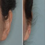 Otoplasty Before and After Photos in Miami, FL, Patient 1322