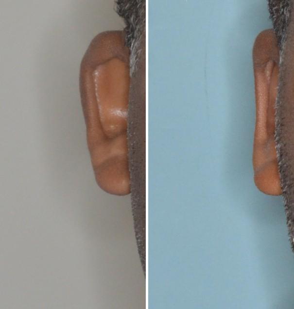 Otoplasty Before and After Photos in Miami, FL, Patient 1329