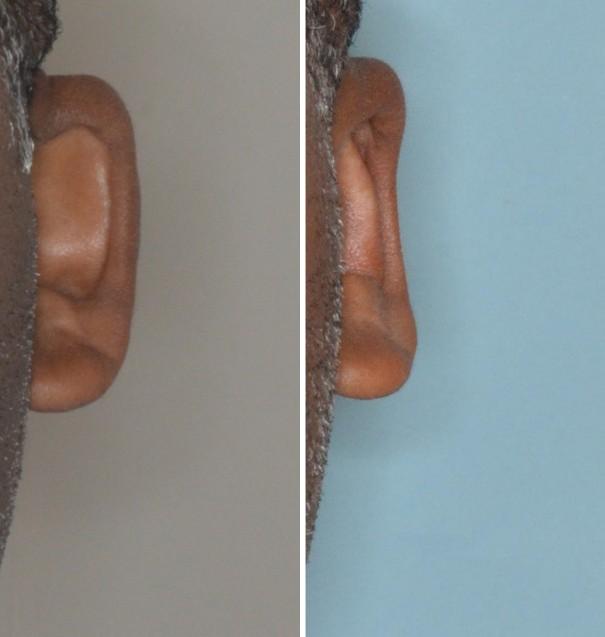 Otoplasty Before and After Photos in Miami, FL, Patient 1329