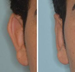 Otoplasty Before and After Photos in Miami, FL, Patient 1336