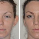 Otoplasty Before and After Photos in Miami, FL, Patient 1347