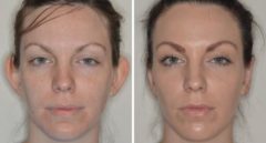 Otoplasty Before and After Photos in Miami, FL, Patient 1347