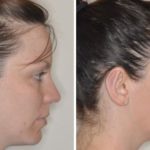 Otoplasty Before and After Photos in Miami, FL, Patient 1347